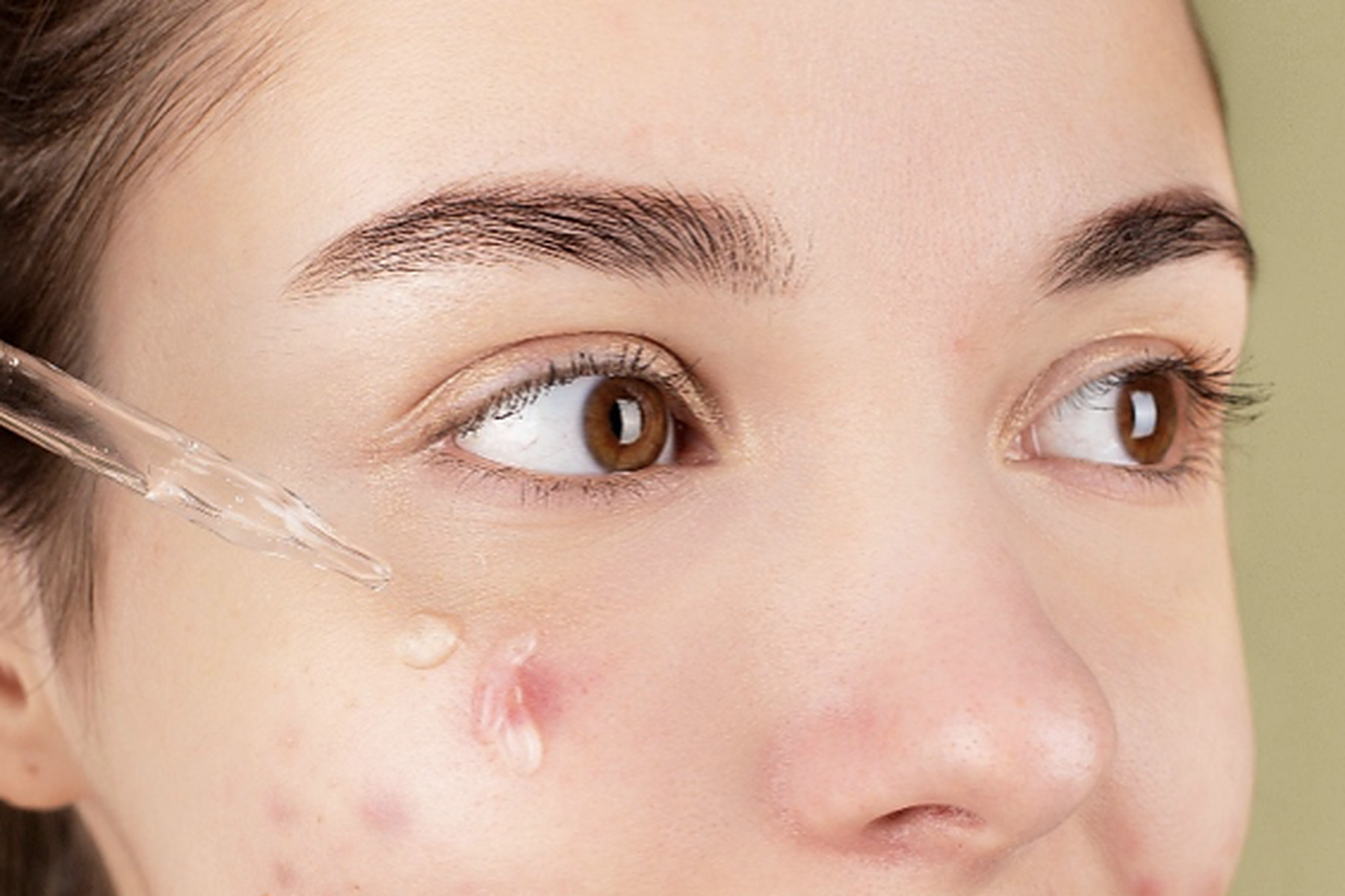 Acne and Skin Inflammation